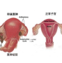 我一直痛经，昨天去医院做了一个彩超，做的子宫附件 检查结果是 左侧卵巢囊实性肿物，除外黄体可能。