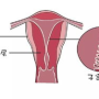 内膜厚1.76cm,子宫内膜厚度